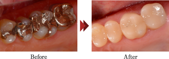 白歯セラミックス修復（CERECによるオールセラミックス修復）