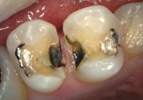 むし歯と除去と神経の保護