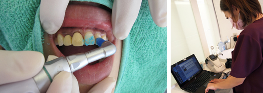 術前の歯のクリーニング、色調データの採取