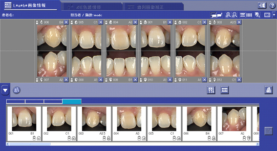 術前の歯の色調を測定し診断