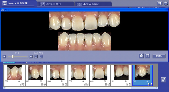術前の歯の色調を測定し診断